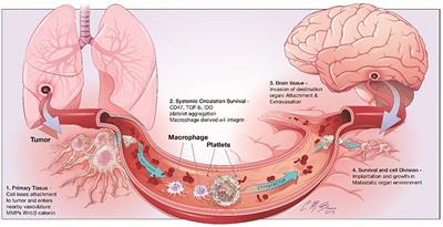 The Immune Microenvironment in Brain Metastases of Non-Small Cell Lung Cancer